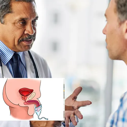 Selecting the Right Type of Penile Implant